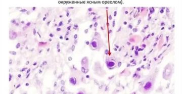 Единичные клетки с крупными ядрами