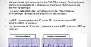 Мерцательная аритмия