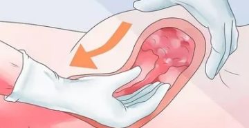 Кровь после секса при беременности