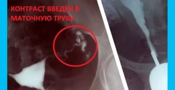 Последствия МСГ