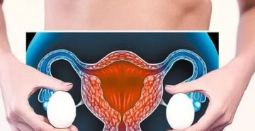 Лечение кисты яичника