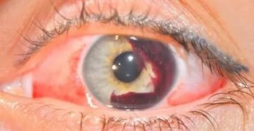 Повреждена слизистая глаза