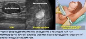 Боль в молочной железе после биопсии полгода