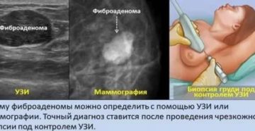 Боль в молочной железе после биопсии полгода