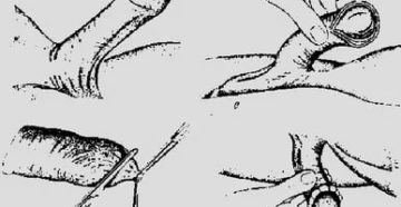 Не могу залупить головку пениса Не могу залупить головку пениса