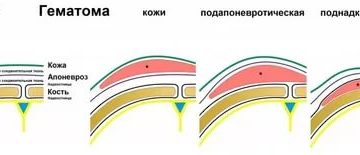 Подапоневротическая гематома на голове