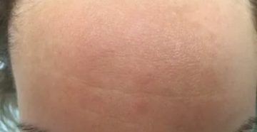 Пятно на лбу