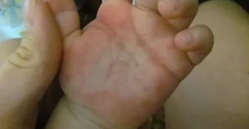 Пятна на ступнях и ладонях ребенка