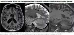 Расшифровка МРТ, Расширение паравазальных пространств