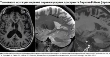 Расшифровка МРТ, Расширение паравазальных пространств