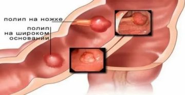 Полип и киста