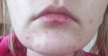 Не проходят прыщи на подбородке в 35