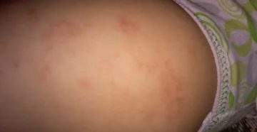 Пятно на бедре у ребенка