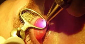 Последствия удаления халязиона