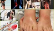 Как снять сильное обострение артрита?