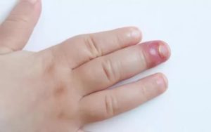 Воспаление на пальце у ребенка