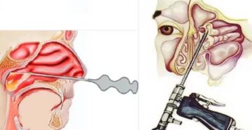 Что делать? Открылось кровотечение после прокола гайморита Что делать? Открылось кровотечение после прокола гайморита