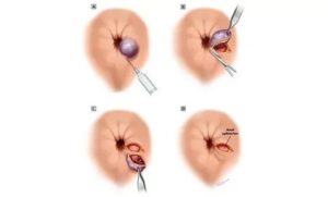 Ранка на геморроидальном узле