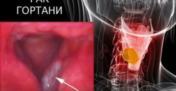 Диагноз рак голосовых связок. После облучения сильно болит горло Диагноз рак голосовых связок. После облучения сильно болит горло