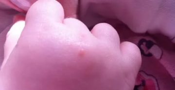 Странные прыщи у ребенка