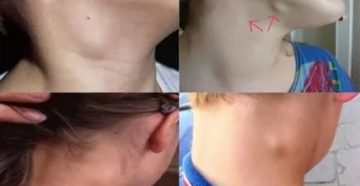 Увеличенные безболезненные лимфоузлы