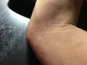 Сухая и шелушащаяся кожа спины с огрубевшими пятнами больше года