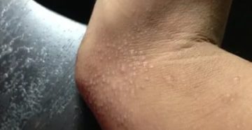 Сухая и шелушащаяся кожа спины с огрубевшими пятнами больше года