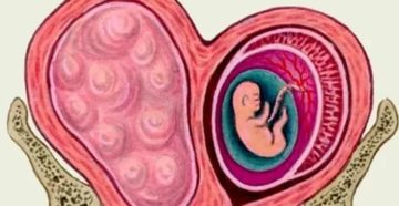 Признаки беременности при миоме