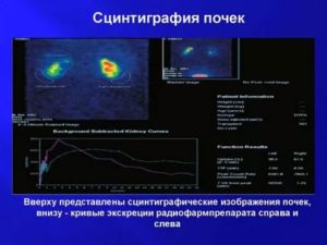 Неравномерное распределение РФП при проведении динамической сцинтиграфии почек