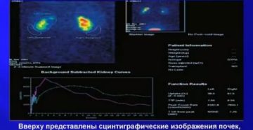 Неравномерное распределение РФП при проведении динамической сцинтиграфии почек