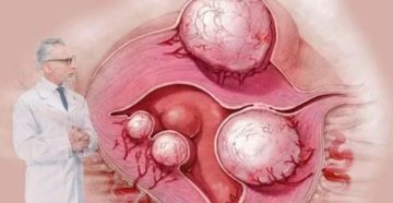 Множественная миома матки, размер 4,5 см