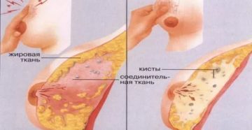 Уплотнение и боль в груди после месячных