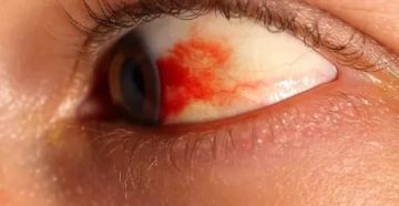 Сосуды в глазу и фиолетовое пятно Сосуды в глазу и фиолетовое пятно