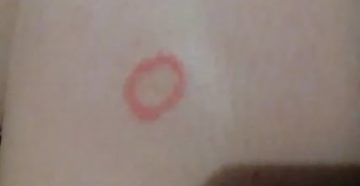 Пятно в форме круга на руке Пятно в форме круга на руке