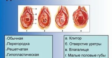 После лишения девственности больно писать