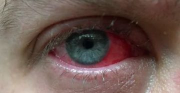 Послеоперационное воспаление глаза