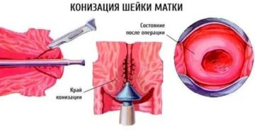 Задержка после конизации шейки матки