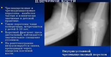 Закрытый краевой перелом дистального метаэпифиза плечевой кости