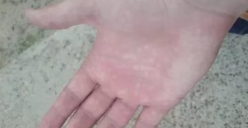 Фасцикулярные подергивания сосуды Фасцикулярные подергивания сосуды