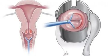 Конизация шейки матки