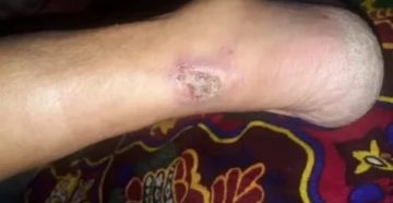 Не заживает сухая болячка Не заживает сухая болячка