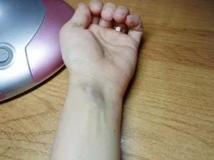 Вздулась вена на запястье