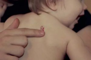 Гемангиома на плече у ребенка