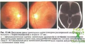 Дисплазия диска зрительного нерва