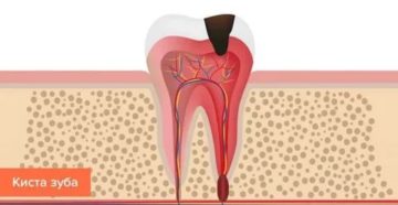 Боли после удаления зуба с кистой