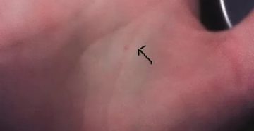 Неизвестная красная точка на ладони Неизвестная красная точка на ладони