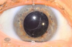 Вторичная катаракта