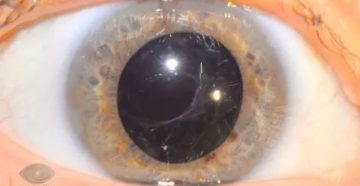 Вторичная катаракта