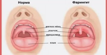 Фарингит во время беременности Фарингит во время беременности