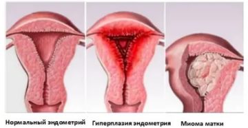 Гиперплазия эндометрия и обильные месячные
